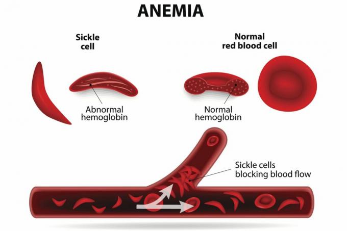 Anemia sierpowata